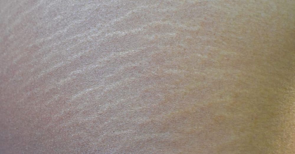 stretch-marks-on-breasts-causes-treatment-prevention-more